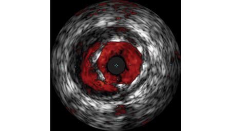 Stent apposition assessment