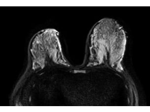 IRIS - Breast Visualize finer structures within the body with high-quality DWI