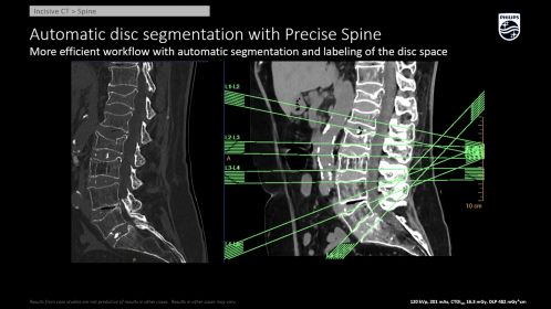 Incisive CT Precise Spine