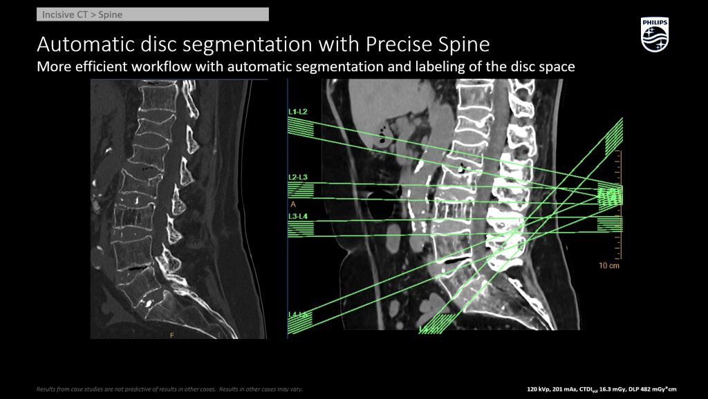 Incisive CT Precise Spine