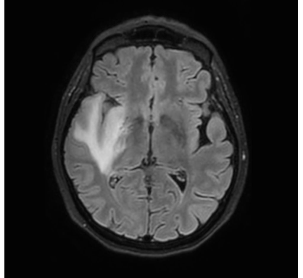 3D BrainVIEW FLAIR
