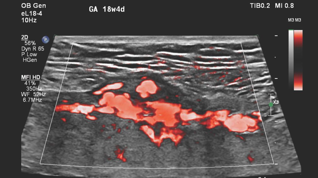 Figure 7 eL18-4 transducer MFI HD image of the suspected placental abnormality.