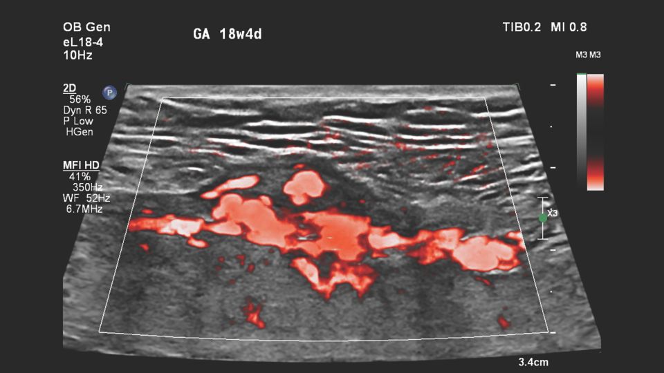 Figure 7 eL18-4 transducer MFI HD image of the suspected placental abnormality