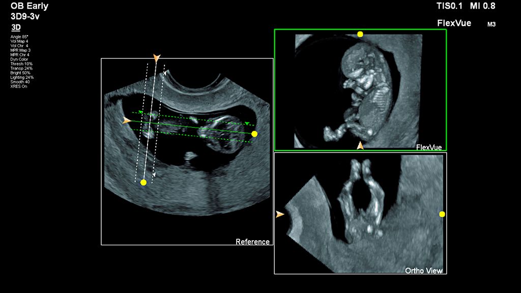 Fetal image using FlexVue with Orthogonal View