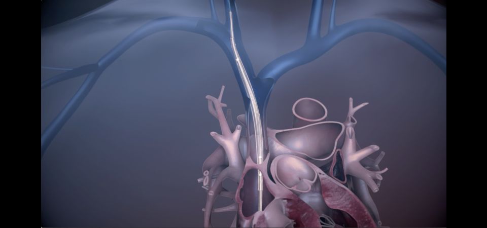 Bridge to surgery 