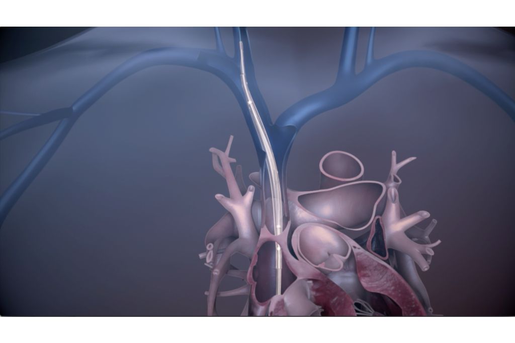 Bridge to surgery 