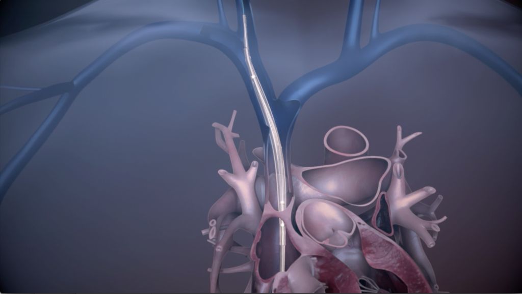 Bridge to surgery 