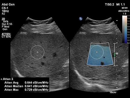 C5-1 Liver Fat Quantification