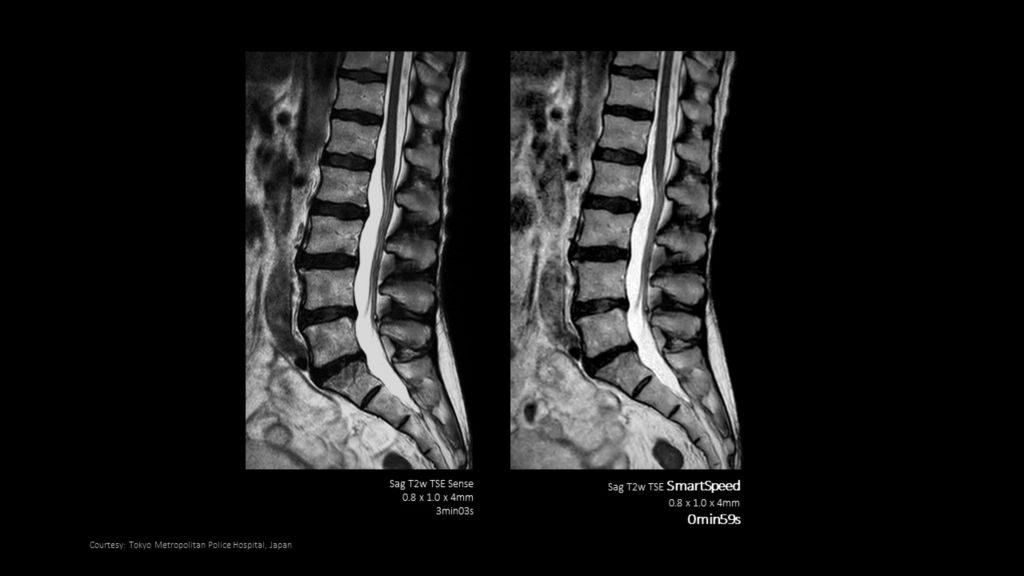 SmartSpeed -Spine