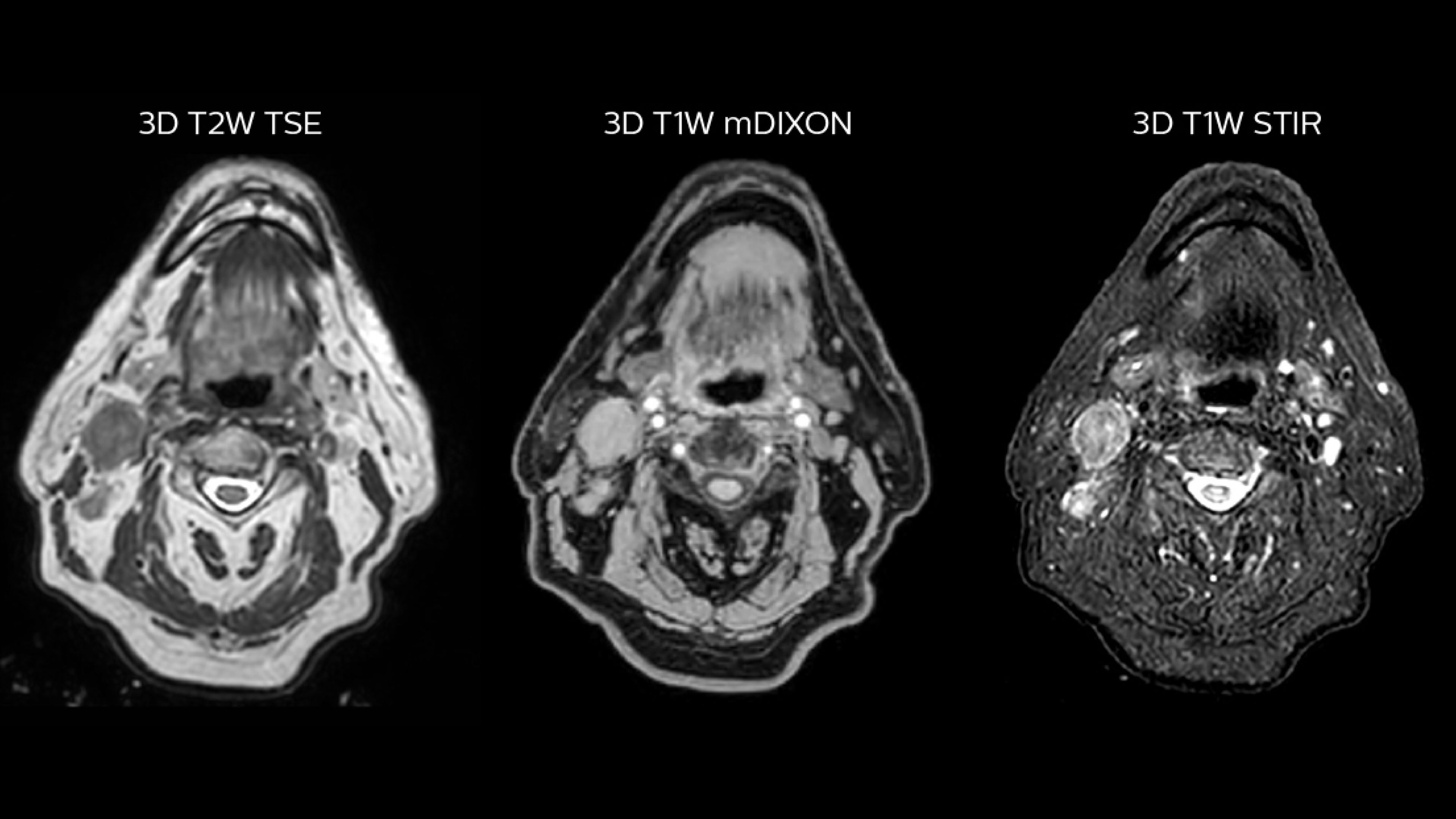 Simulation imaging of patient with an epidermoid carcinoma 
