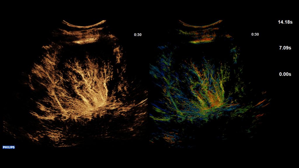 SuperRes MVI on the EPIQ Elite platform.