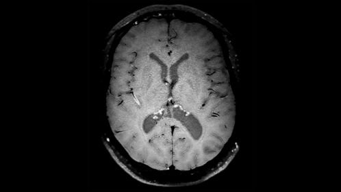 Axial 3D Black Blood imaging (vasculitis)