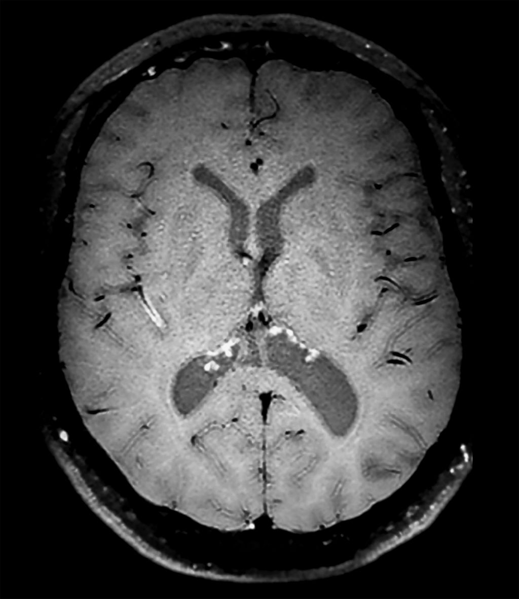 Axial 3D Black Blood imaging (vasculitis)