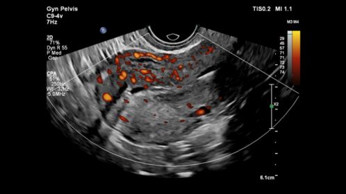 Gyn Pelvis ultrasound image shown with CPA using C9-4v transducer