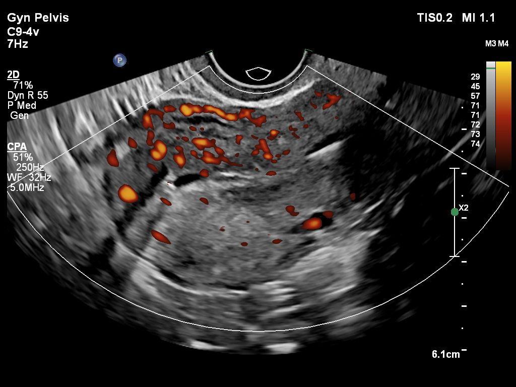Gyn Pelvis ultrasound image shown with CPA using C9-4v transducer