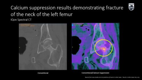 IQon Spectral Calcium Suppression | Fracture of the femur neck