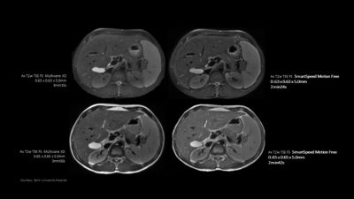Philips - SmartSpeed MotionFree Body - Abdomen HCNMRF449E