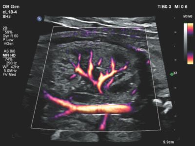Flow Viewer applied to MFI HD with eL18-4 fetal kidney