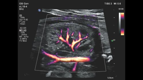 Flow Viewer applied to MFI HD with eL18-4 fetal kidney