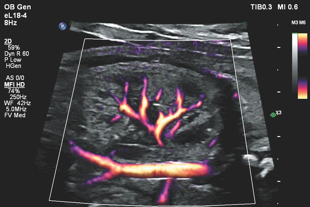 Flow Viewer applied to MFI HD with eL18-4 fetal kidney