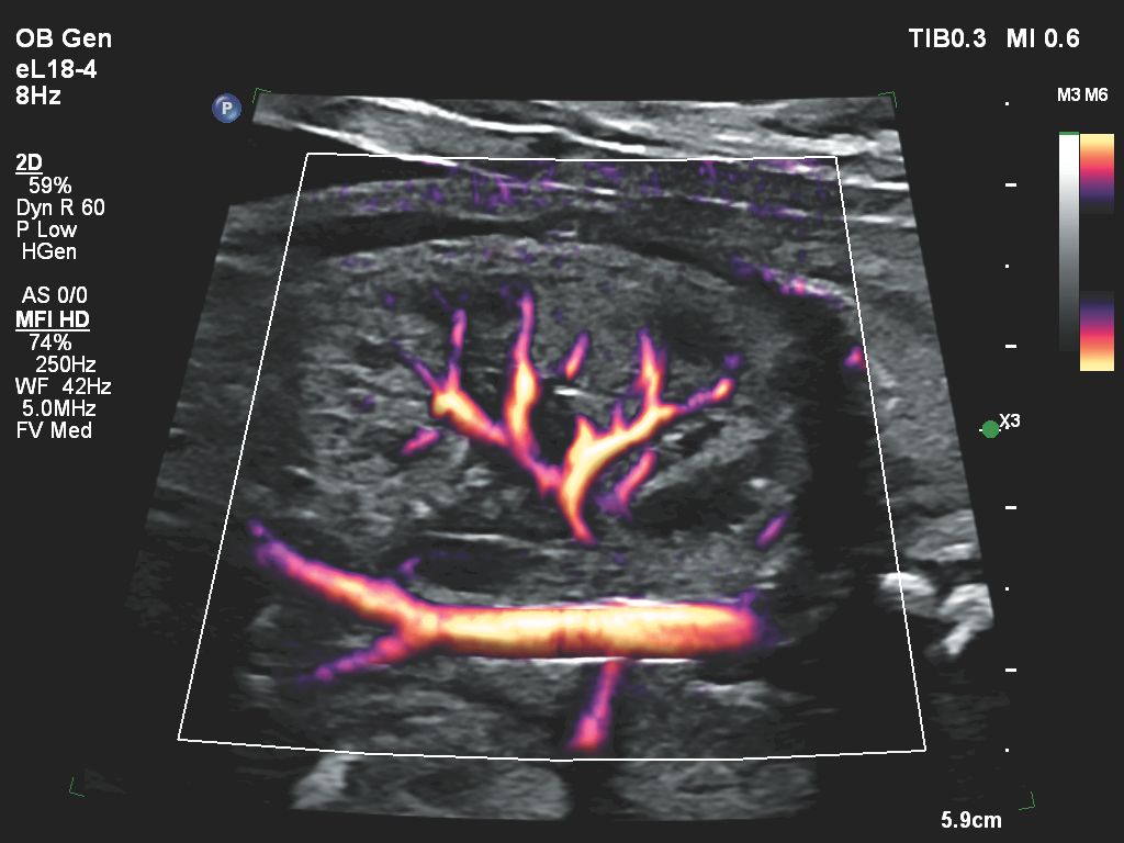 Flow Viewer applied to MFI HD with eL18-4 fetal kidney