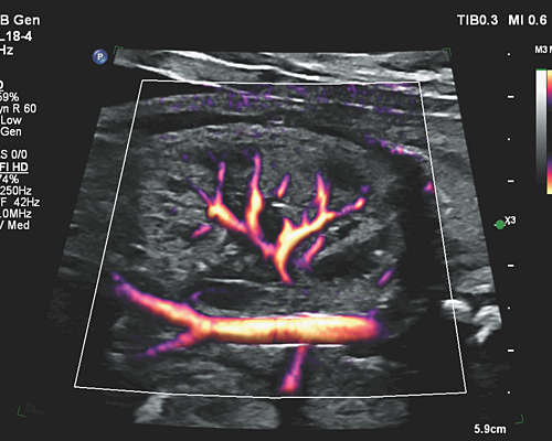 Flow Viewer applied to MFI HD with eL18-4 fetal kidney