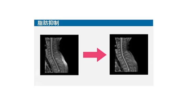 MRI scan