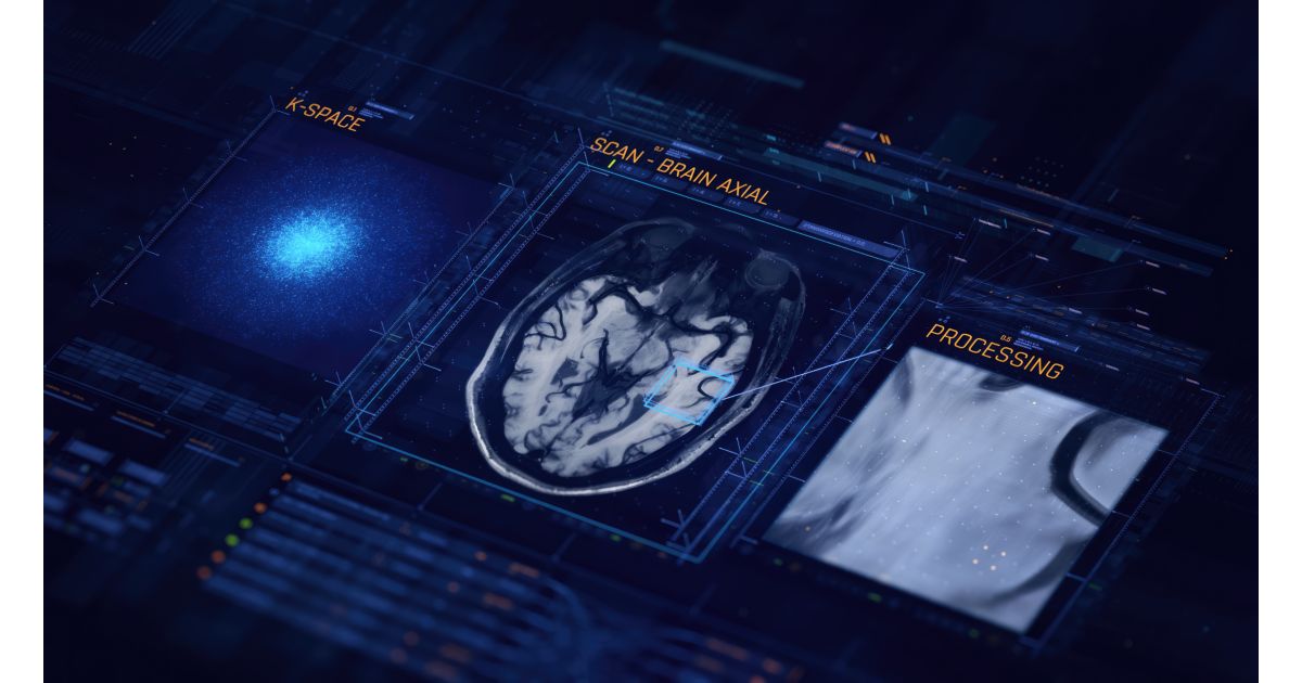 SmartSpeed at Miami Cardiac-Vascular - Philips