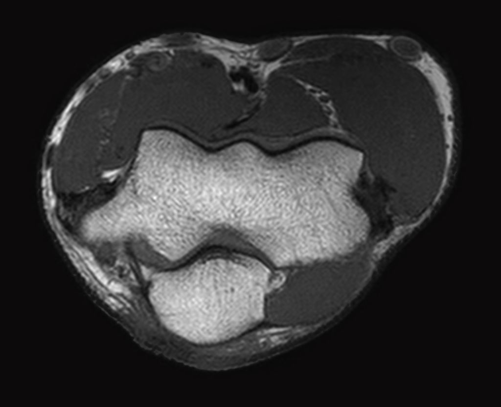 Axial T1w TSE - Elbow