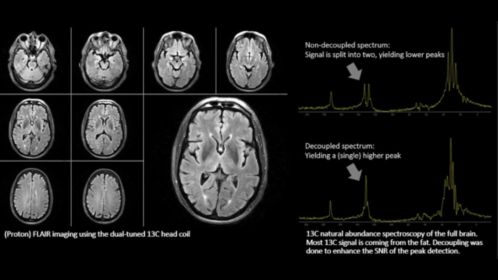 Multi Nuclei Brain exam 1H and 13C