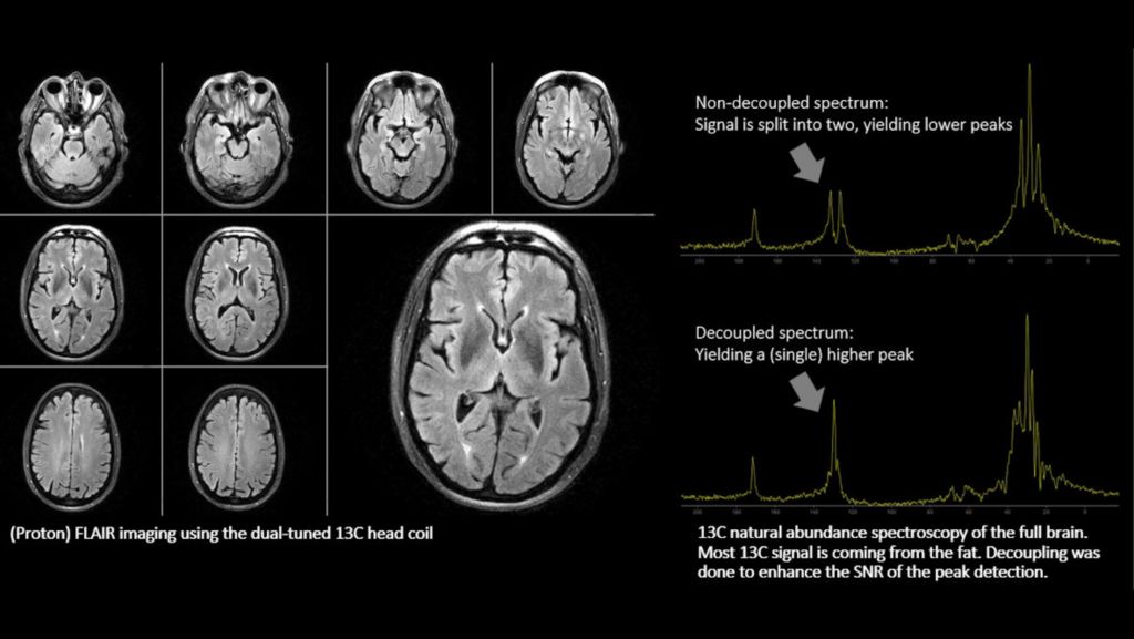 Multi Nuclei Brain exam 1H and 13C
