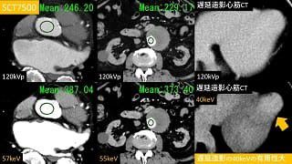 case 80
心臓CTでの応用②