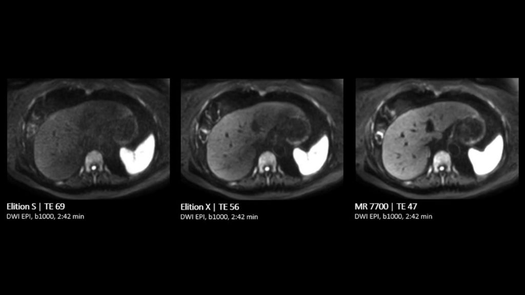 Liver Comparison DWI EPI b1000