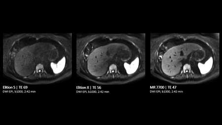 Liver Comparison DWI EPI b1000