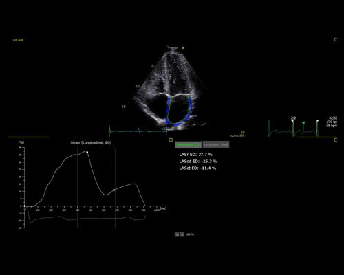 Echo, TOMTEC, Ultrasound Workspace interface AutoStrain