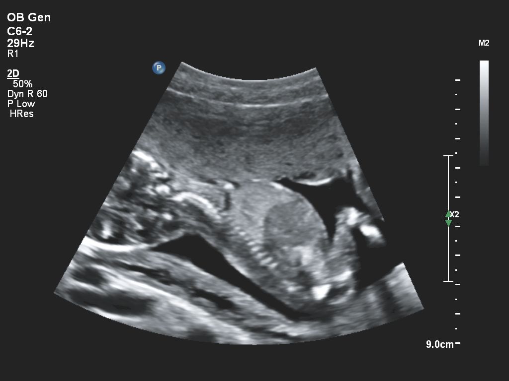 Affiniti 30 ultrasound clinical image fetal
