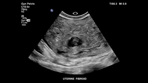 Uterine fibroid