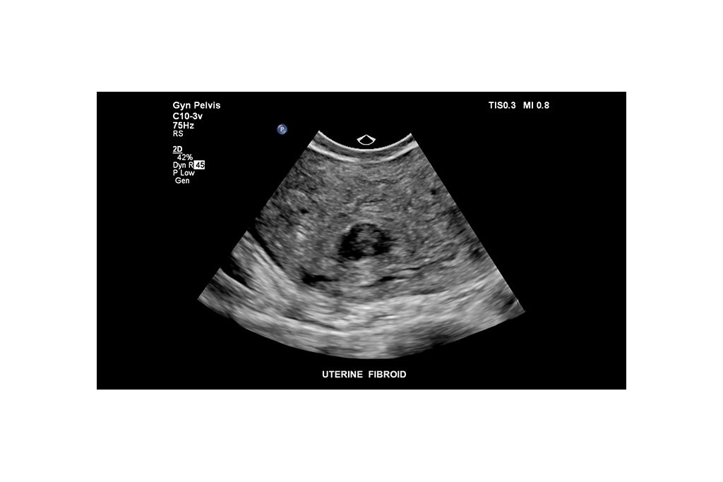 Uterine fibroid