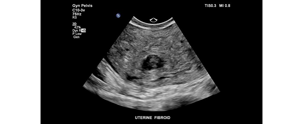 Uterine fibroid