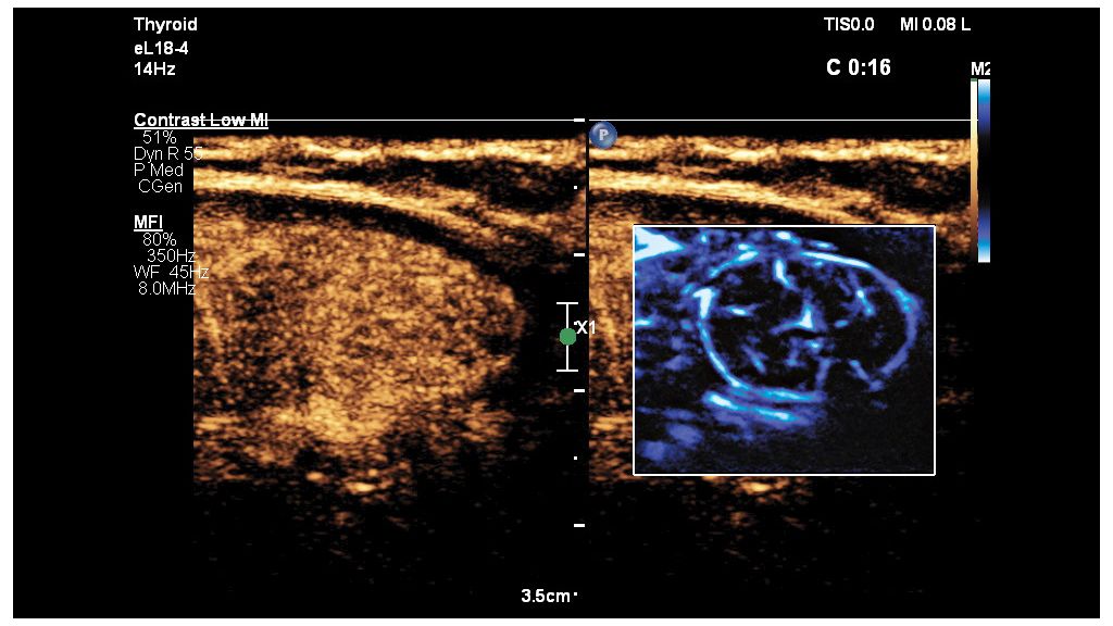 Thyroid image