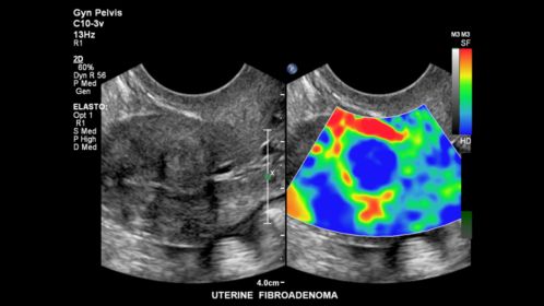 Strain elastography demonstrating increased stiffness of an intrauterine fibroadenoma