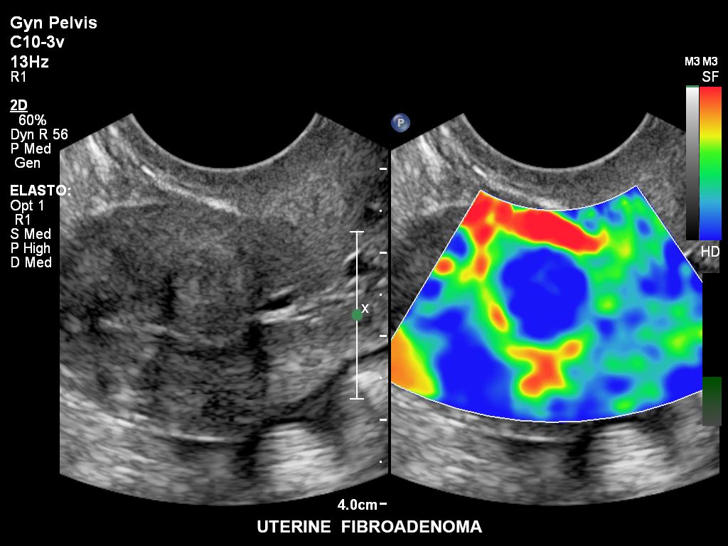 Strain elastography demonstrating increased stiffness of an intrauterine fibroadenoma