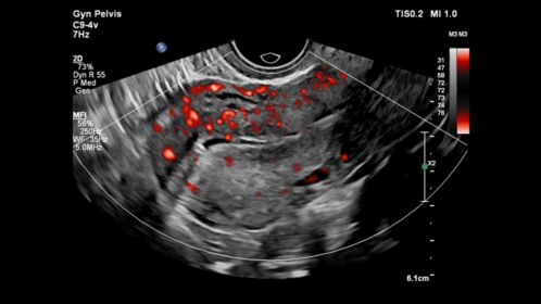 Gyn Pelvis ultrasound image shown with MFI using C9-4v transducer