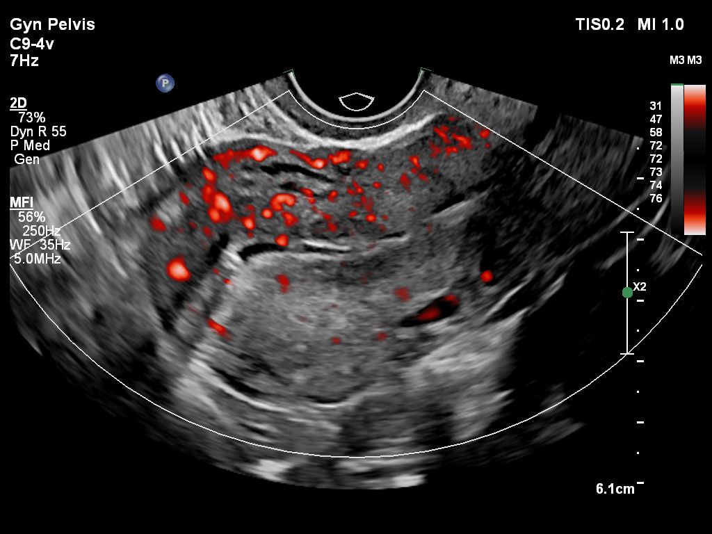 Gyn Pelvis ultrasound image shown with MFI using C9-4v transducer