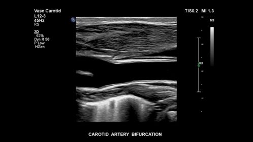 Carotid bifurcation