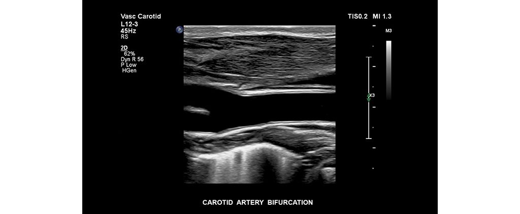 Carotid bifurcation