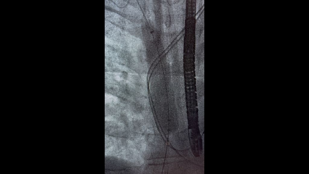 Fluoroscopy of Bridge Plus – Image courtesy of Cleveland Clinic