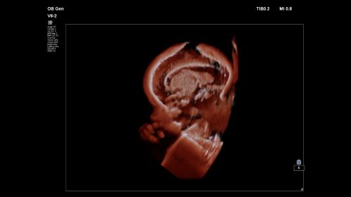 Fetal brain shown with TrueVue on V6-2 transducer