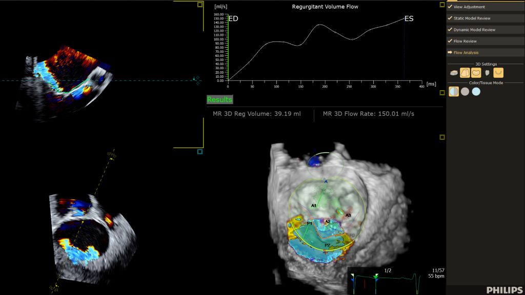 3D Automated Color Flow Quantification (3D Auto CFQ) provides an important measurement for mitral valve regurgitation assessment.