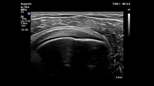 eL18-4 MSK Shoulder